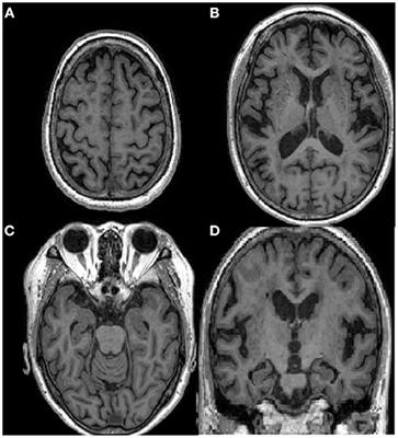 Case Report: De Clerambault's Syndrome in Dementia With Lewy Bodies